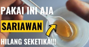 cara menyembuhkan sariawan dalam 5 menit 0